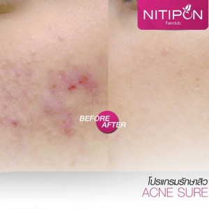 acne2